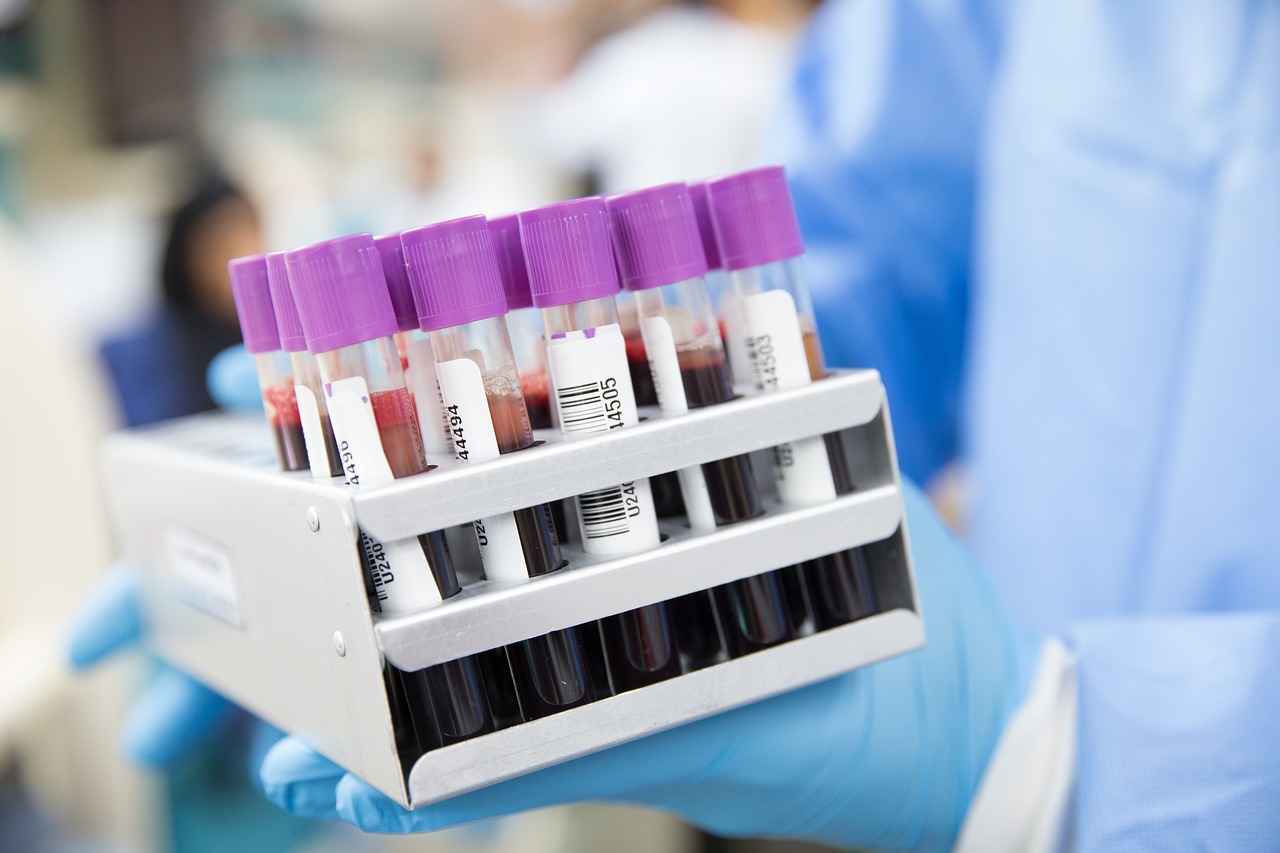 Guide til blod- og urinprøvesvar ved diabeteskontroll